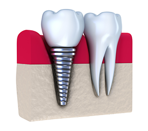 Dental Implants in Stafford, VA